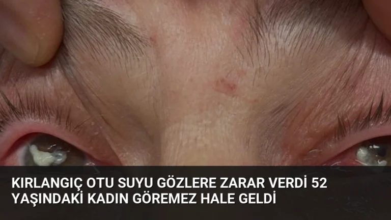 Kırlangıç Otu Suyu Gözlere Zarar Verdi 52 Yaşındaki Kadın Göremez Hale Geldi
